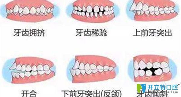 牙齒不整齊的六種癥狀