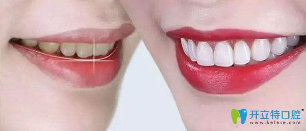 收獲健康牙齒需從清潔開始