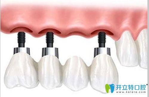 呂學(xué)良醫(yī)生科普什么是種植牙二期修復(fù)