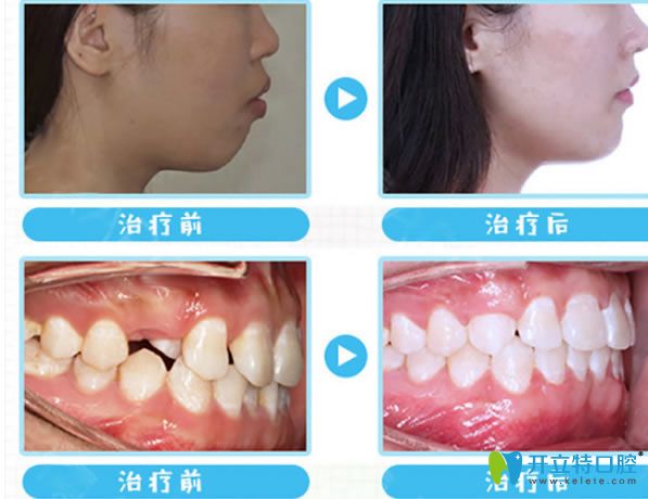<!--<i data=20240703-sp></i>-->成人隱適美矯正案例對(duì)比圖