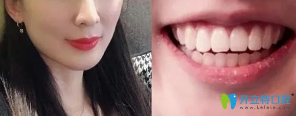 威海舒好口腔劉炳黎院長正畸案例術(shù)后照