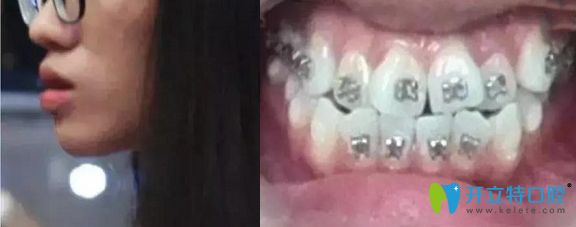 威海舒好口腔金屬托槽矯正案例術(shù)前照
