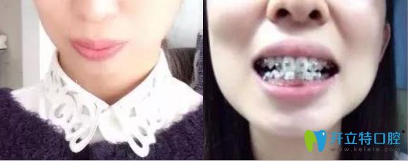 威海舒好口腔劉炳黎院長牙齒正畸案例效果