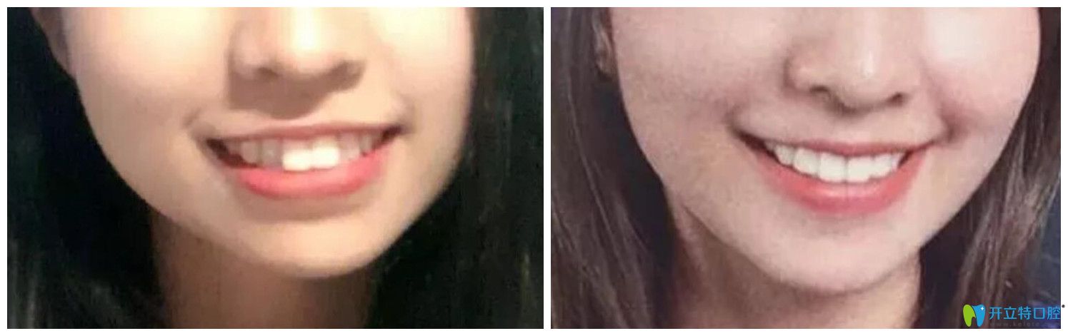藝星口腔牙齒矯正案例前后效果對比圖