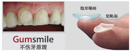 陳杰講解瓷貼面優(yōu)缺點