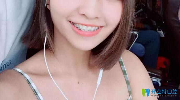 牙齒畸形戴牙套一年半樣子