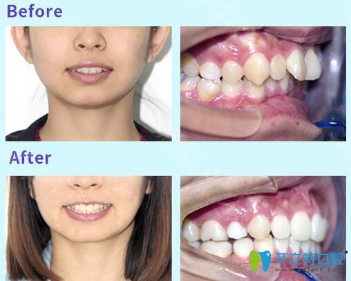 沈陽歡樂口腔牙齒矯正案例