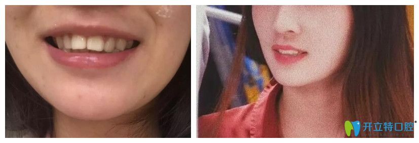西安哪個(gè)醫(yī)院矯正牙齒比較好？來看藝星牙齒矯正案例