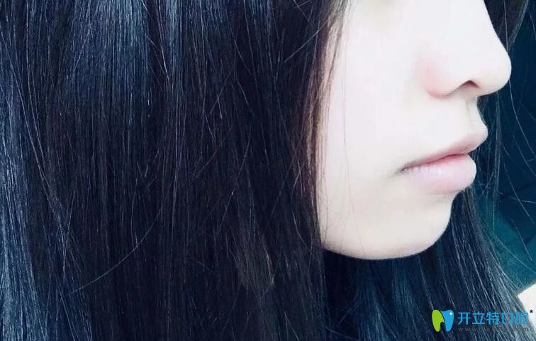 西安藝星門牙前突矯正214天側臉圖