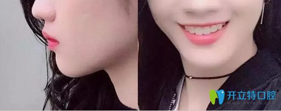 威海舒好口腔牙齒不齊擁擠矯正術(shù)后照