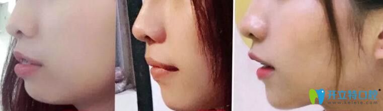 牙齒矯正左60天、中235天、右567天側臉對比變化圖