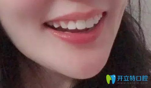 在青島諾德口腔做過(guò)齙牙矯正后的照片