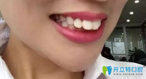 在青島諾德做完隱適美齙牙矯正后分享一份牙齒矯正價(jià)格表