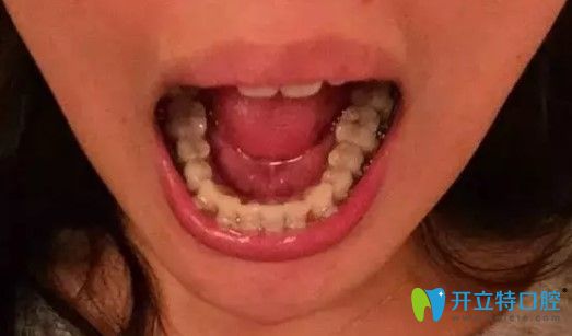 戴隱適美隱形牙套8個(gè)月的照片