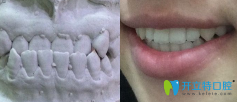 我的牙齒反頜是在上海圣康口腔戴金屬托槽牙套矯正好的！