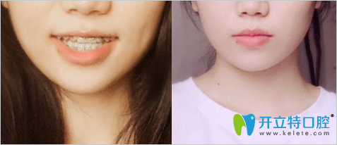 <!--<i data=20240703-sp></i>-->圣康牙科做牙齒反頜矯治術(shù)中照 <!--<i data=20240703-sp></i>-->圣康牙科做牙齒反頜矯治術(shù)中照