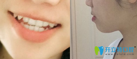 <!--<i data=20240703-sp></i>-->圣康口腔地包天牙齒矯正術(shù)前照 <!--<i data=20240703-sp></i>-->圣康口腔地包天牙齒矯正術(shù)前照