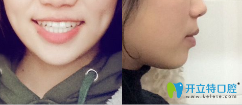 我在<!--<i data=20240703-sp></i>-->圣康口腔戴金屬托槽牙套矯正好了牙性反頜 我在<!--<i data=20240703-sp></i>-->圣康口腔戴金屬托槽牙套矯正好了牙性反頜