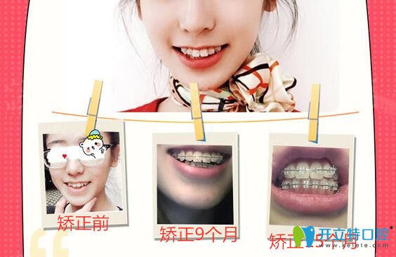 廣州圣貝口腔半隱形陶瓷托槽牙齒矯正案例