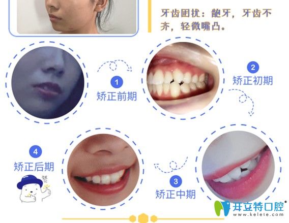 格倫菲爾正畸過程牙齒變化圖