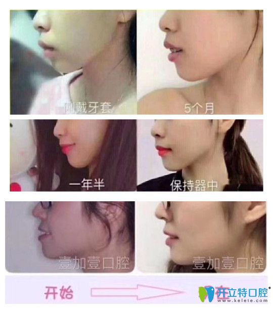 廣州壹加壹口腔牙齒矯正實(shí)例療效對(duì)比圖