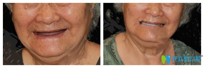 鄭州拜博口腔全口種植案例