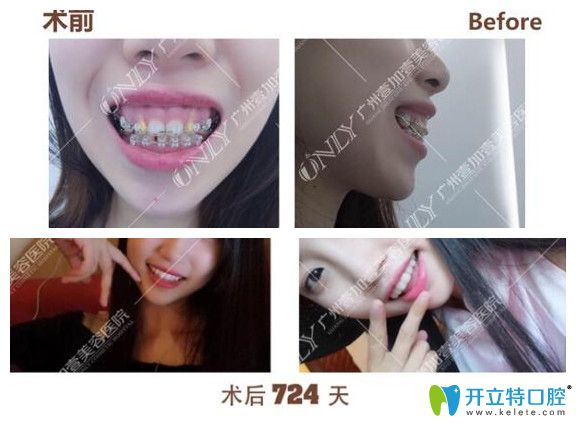廣州壹加壹口腔露齦笑矯正前后臉型變化圖效果對(duì)比