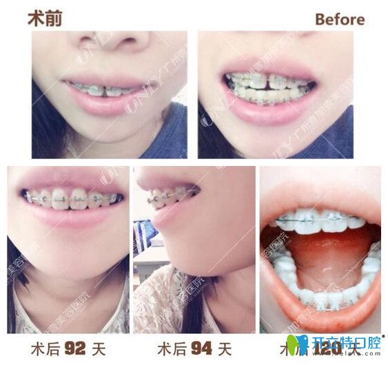 壹加壹齙牙，門牙縫隙矯正過程中牙齒變化圖