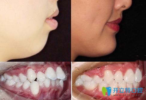 佛山春芽口腔牙齒矯正改變臉型的<span style=