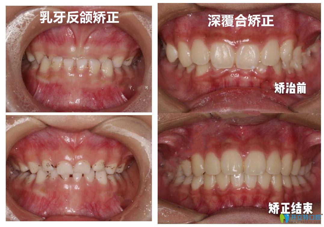 深圳美萊口腔韓旭醫(yī)生做牙齒矯正怎么樣？有案例為證哦