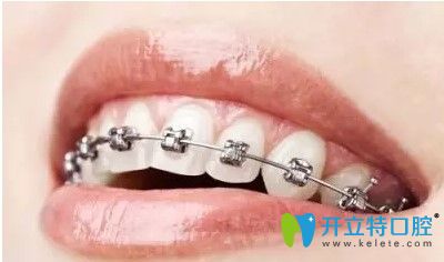 深圳諾德齒科金屬托槽牙齒矯正