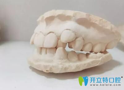 虎牙+擁擠,找廣州壹加壹口腔戚志鋒做自鎖托槽矯正一次搞定