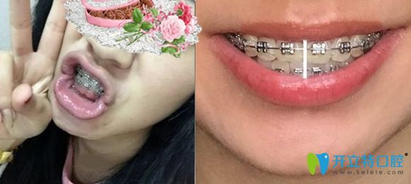 濟南韓氏口腔金屬托槽牙套矯正1年效果圖 濟南韓氏口腔金屬托槽牙套矯正1年效果圖
