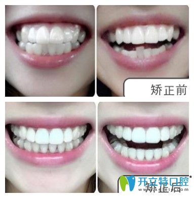 衡陽(yáng)雅美口腔顧客矯正案例圖