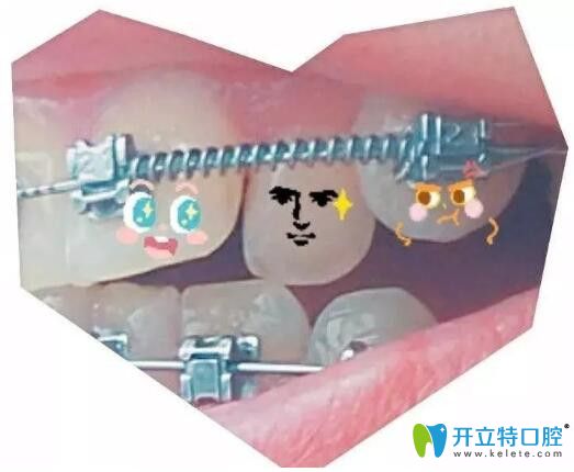 我在廣州壹加壹戴的自鎖托槽矯正器