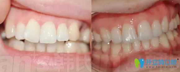 濟南韓氏口腔牙性齙牙矯正效果對比圖