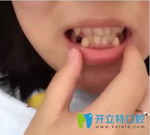 順德矯正牙齒哪個(gè)醫(yī)院好呢?壹加壹口腔齙牙正畸效果供參考