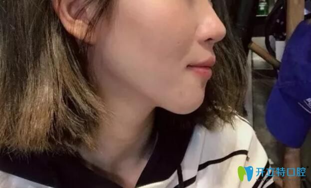 義烏傅氏口腔下牙套后側(cè)臉效果圖