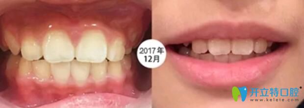 8歲的兒子在成都河馬口腔做矯正6個(gè)月