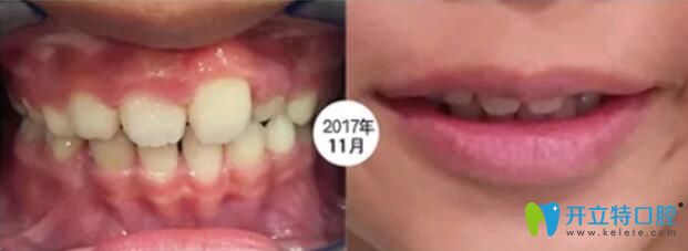 孩子在成都河馬口腔做矯正第4個(gè)月