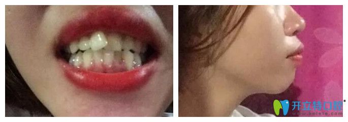 牙齒矯正可以改變臉型嗎?義烏傅氏口腔正畸經(jīng)歷來驗(yàn)證
