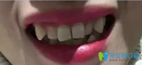 牙性齙牙突嘴的我,在珠海九龍口腔做牙齒矯正兩年就整齊了!