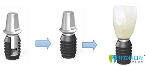 美國(guó)百康種植牙過(guò)程示意圖