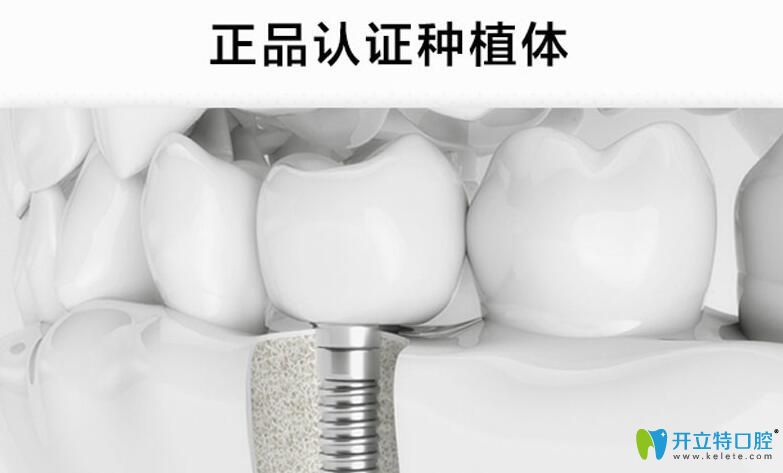南昌輝煌口腔所使用的正品種植體 南昌輝煌口腔所使用的正品種植體