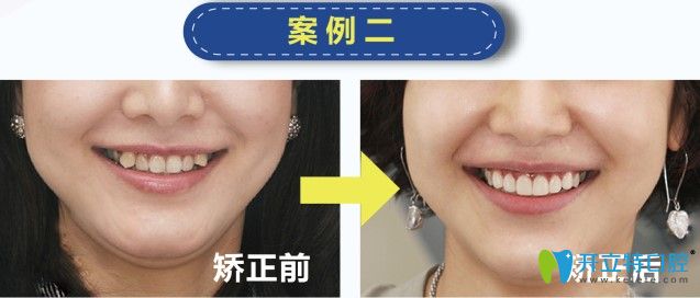 歡樂(lè)仁愛(ài)口腔虎牙矯正案例