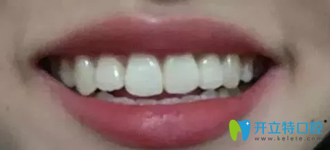 珠海九龍口腔牙性齙牙突嘴矯正兩年效果圖