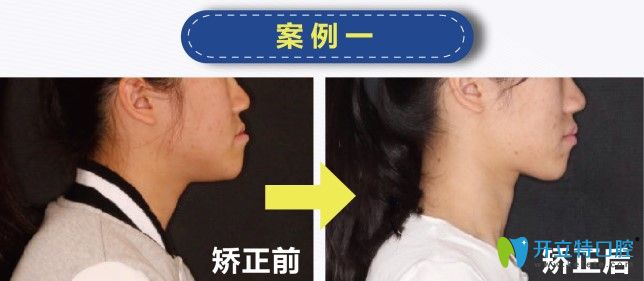 歡樂(lè)仁愛(ài)口腔地包天矯正案例