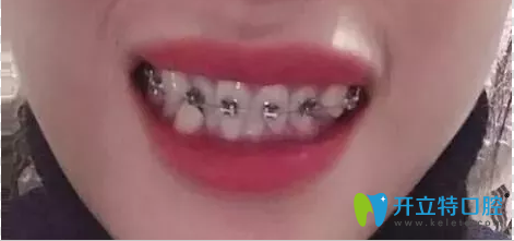 珠海九龍口腔牙齒矯正半年效果