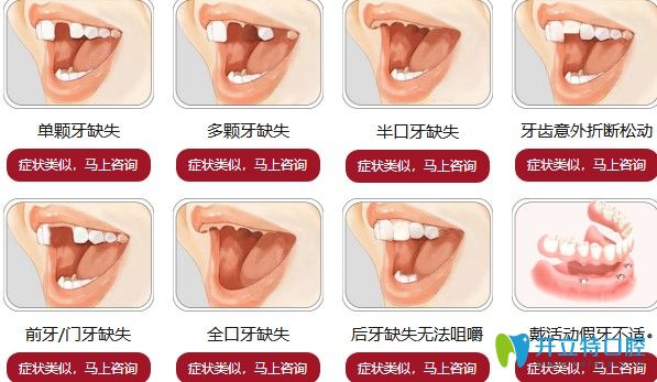 哪些牙齒癥狀需要做種植