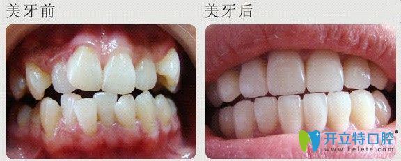 廣州壹加壹口腔牙齒不齊矯正案例